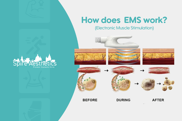 EMS treatment for post pregnancy weight loss treatment Sutton