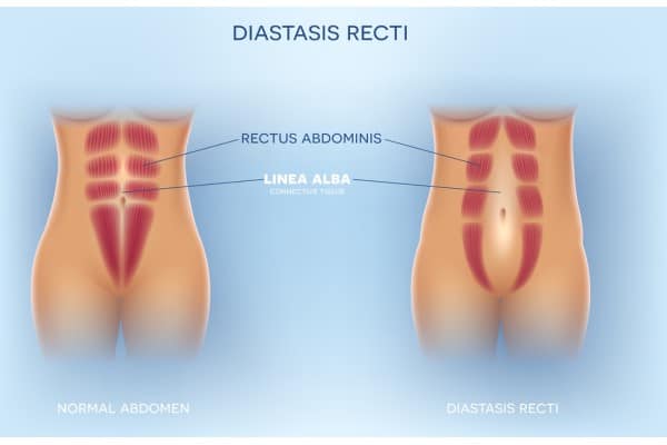 What Non-Surgical Options Are Available for Diastasis Recti Sutton?