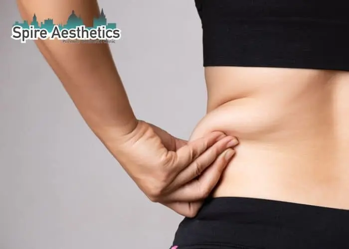 Image of woman pinching fat on their hips Sutton. Fat Freezing treatment