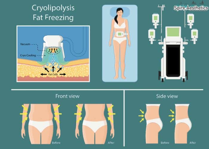 Image of diet and fat freezing combined for best results for Spire Aesthetics Sutton