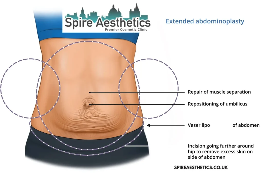Understanding Loose Skin After Gastric Band Sutton Surgery and HIFU Treatment