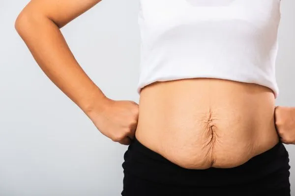 Image of a woman's stomach after weight loss with sagging skin following a gastric band Sutton