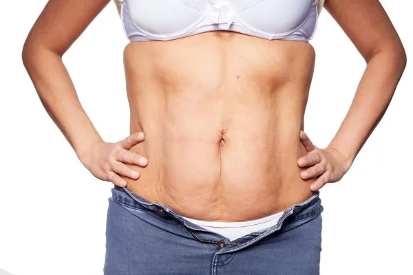 sagging skin on woman's stomach after weight loss injections Sutton