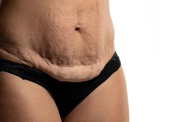 Image of womans stomach after weight loss injections Sutton showing saggy skin