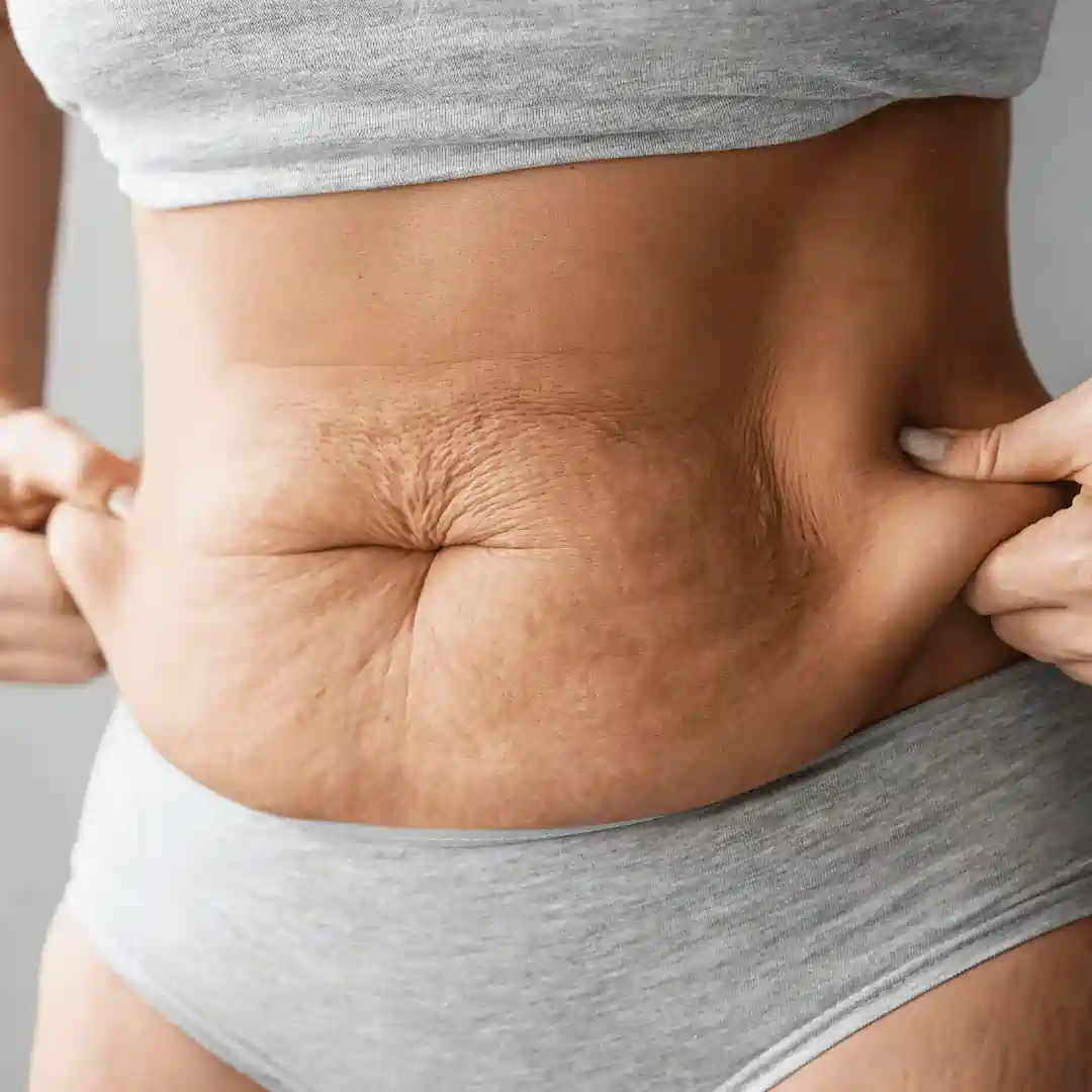 Is It Normal to Have Loose Skin After Pregnancy Sutton?