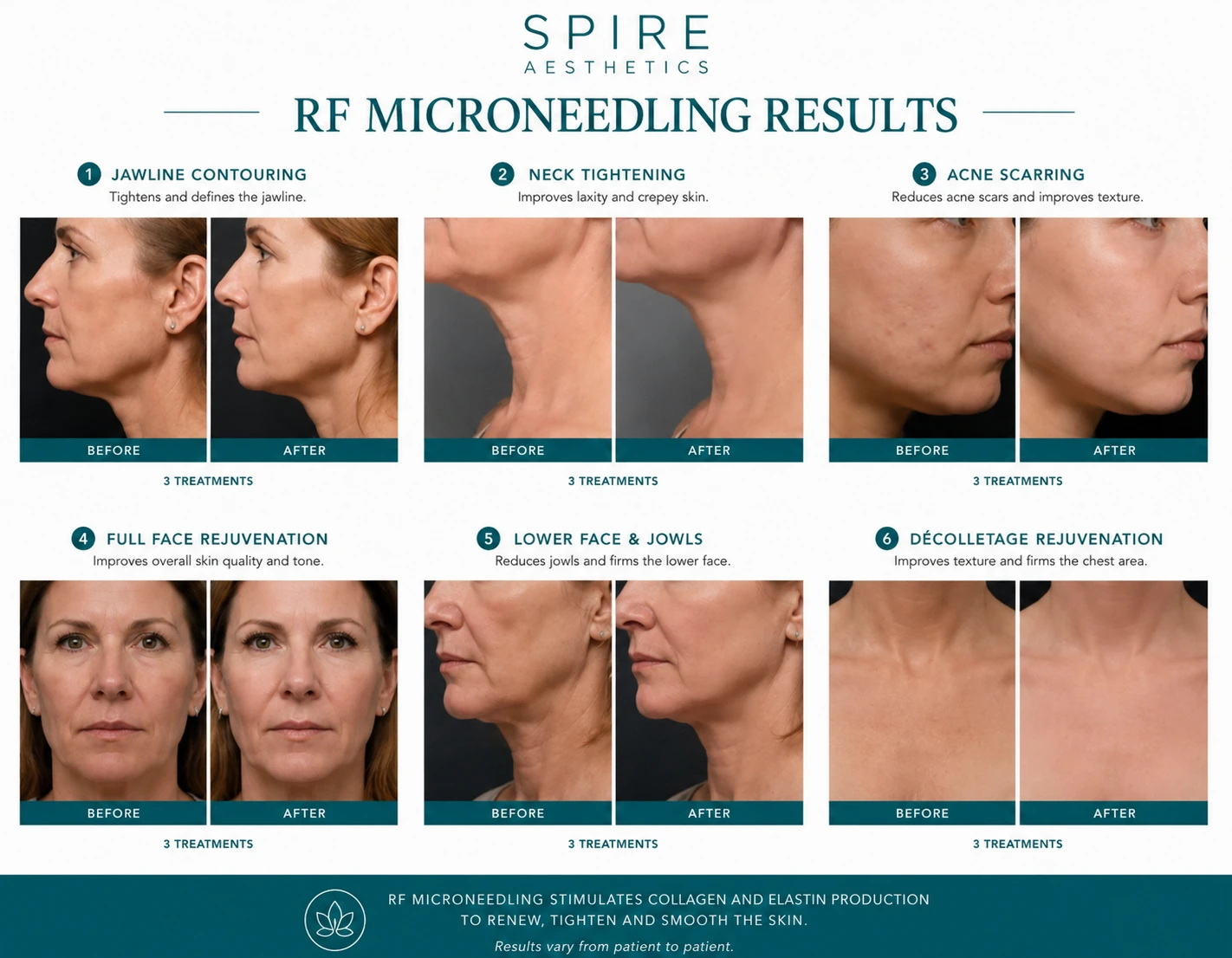 RF Microneedling Skin tightening Sutton results