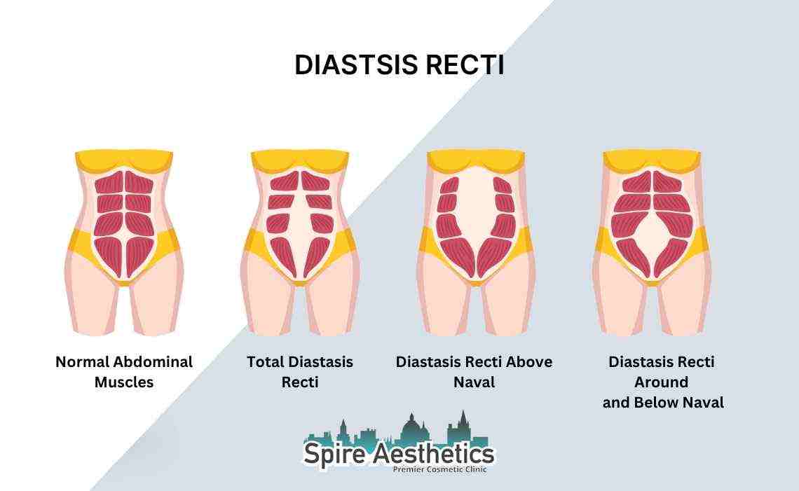 Is Non-Surgical Diastasis Recti Treatment Right for You? Common Concerns Answered Sutton
